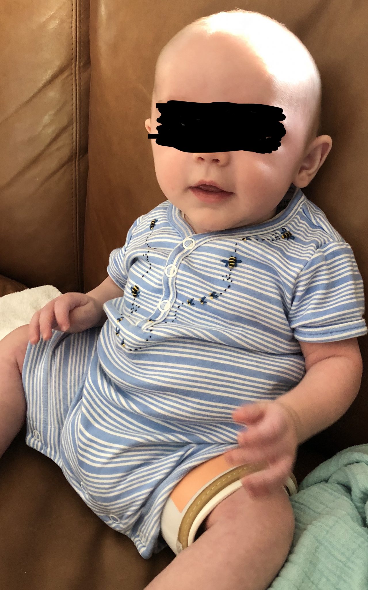 Caring for a Baby with Hip Dysplasia Dr Briony’s Story Adelaide